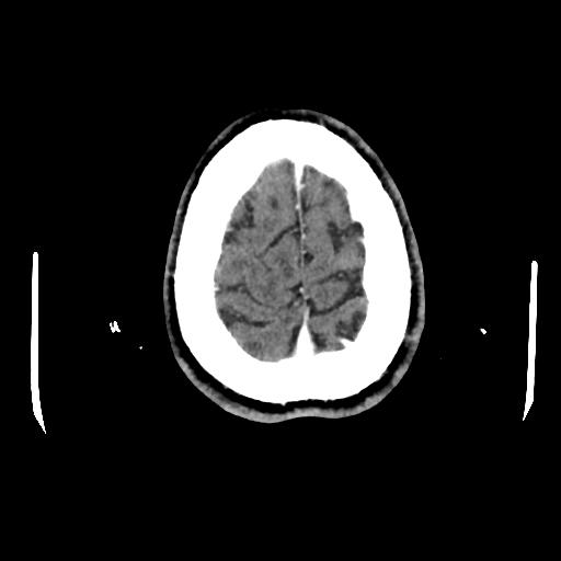 Atretic cephalocele (Radiopaedia 89782-106881 Axial with contrast 169).jpg