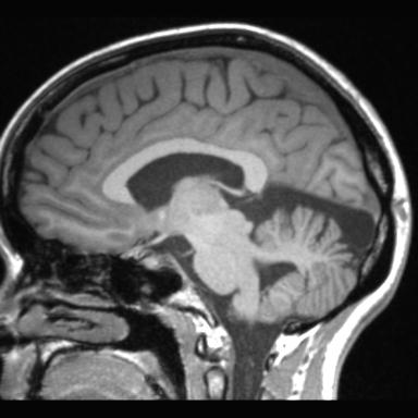 Atretic encephalocoele with inferior vermis hypoplasia (Radiopaedia 30443-31108 Sagittal T1 61).jpg