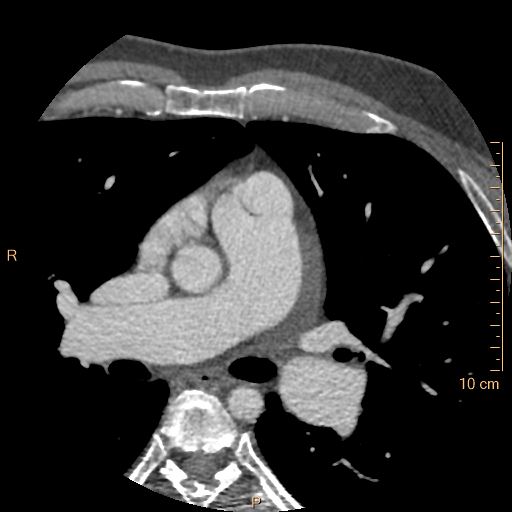 File:Atrial septal defect (upper sinus venosus type) with partial anomalous pulmonary venous return into superior vena cava (Radiopaedia 73228-83961 A 75).jpg