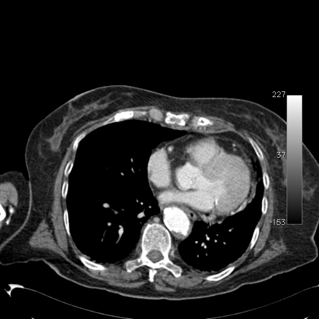 Atypical dissection of the thoracic aorta (Radiopaedia 10975-11393 A 49).jpg