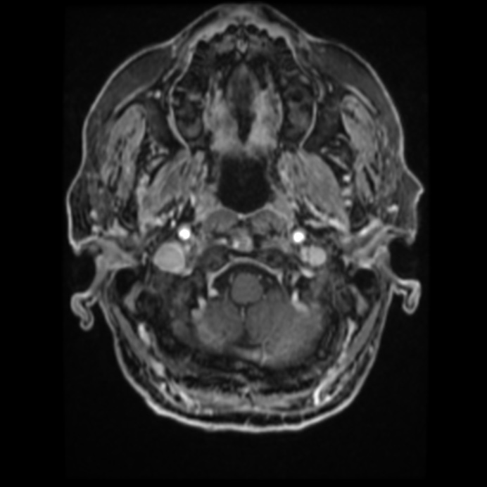 Atypical meningioma (Radiopaedia 45535-49629 Axial T1 C+ 17).jpg