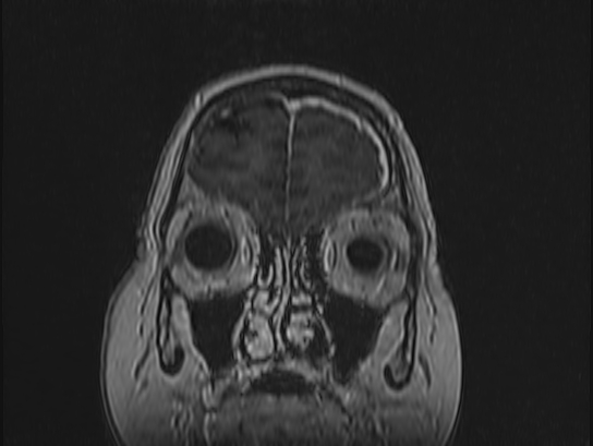 Atypical meningioma (Radiopaedia 62985-71406 Coronal T1 C+ 12).jpg