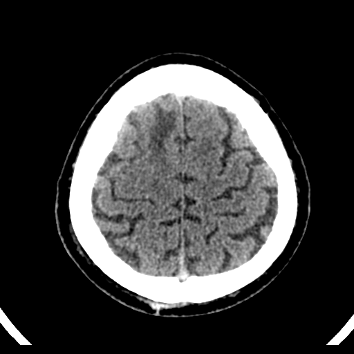File:Atypical meningioma (WHO grade II) with brain invasion (Radiopaedia 57767-64728 Axial non-contrast 38).png