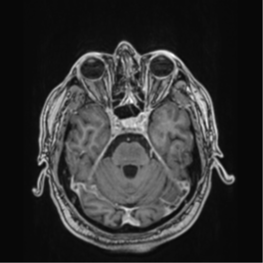 Atypical meningioma (WHO grade II) with brain invasion (Radiopaedia 57767-64729 Axial T1 C+ 14).png