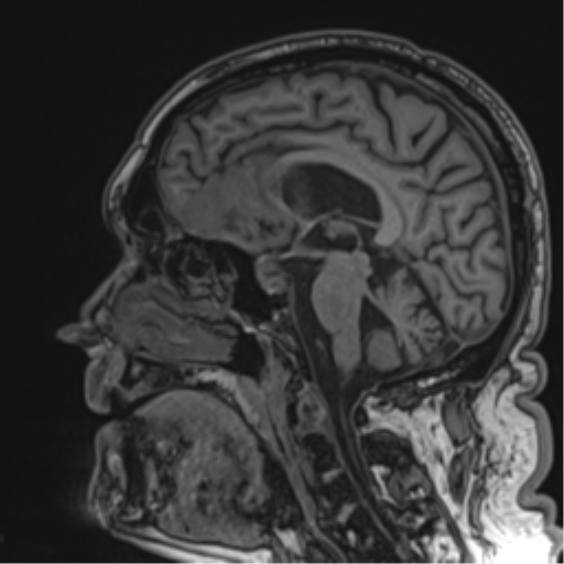 Atypical meningioma (WHO grade II) with brain invasion (Radiopaedia 57767-64729 Sagittal T1 34).png