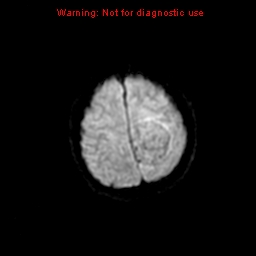 File:Atypical meningioma - grade II (Radiopaedia 13303-13305 Axial DWI 17).jpg