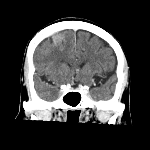 Atypical meningioma with skull invasion (Radiopaedia 34357-35649 Coronal C+ delayed 24).png