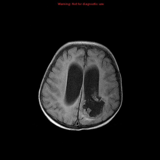 File:Atypical teratoid rhabdoid tumor (Radiopaedia 10712-11183 Axial FLAIR 5).jpg