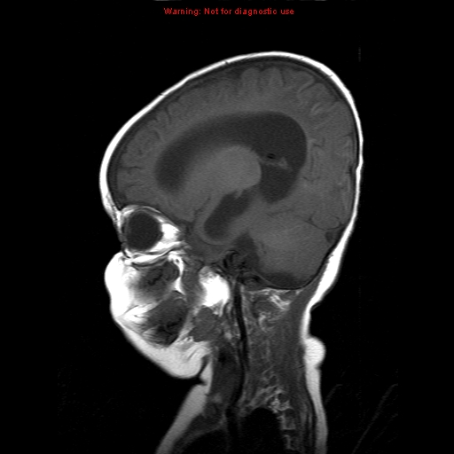 File:Atypical teratoid rhabdoid tumor (Radiopaedia 10712-11183 Sagittal T1 7).jpg