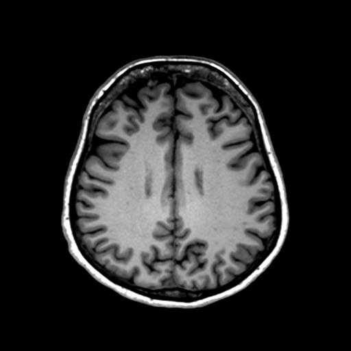 File:Autoimmune limbic encephalitis (Radiopaedia 30363-31005 T1 Axial 1mm 101).jpg