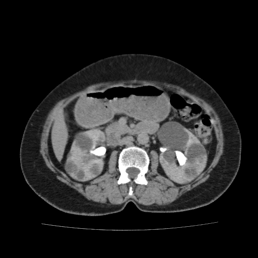 Autosomal dominant polycystic kidney disease (Radiopaedia 38189-40194 Axial C+ delayed 21).jpg