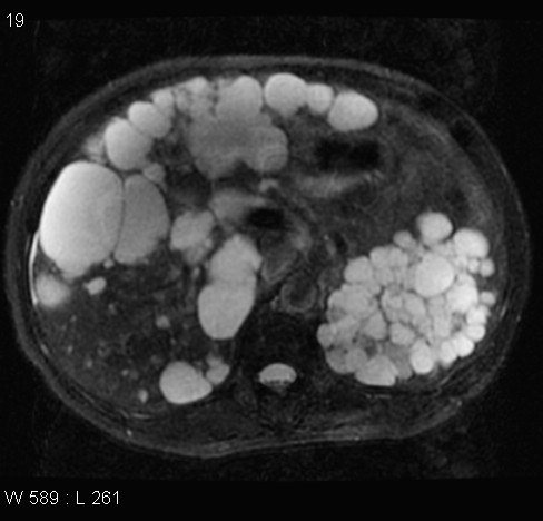 File:Autosomal dominant polycystic kidney disease (Radiopaedia 5202-6969 Axial T2 fat sat 7).jpg