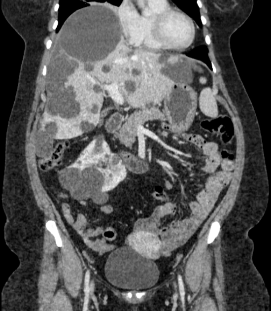 Autosomal dominant polycystic kidney disease (Radiopaedia 57124-64017 B 30).jpg