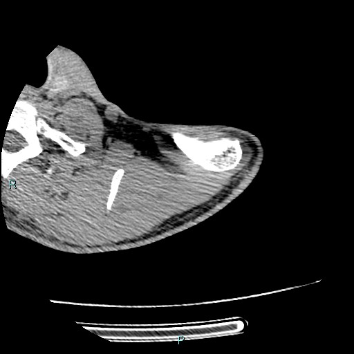 File:Avascular necrosis after fracture dislocations of the proximal humerus (Radiopaedia 88078-104655 D 23).jpg