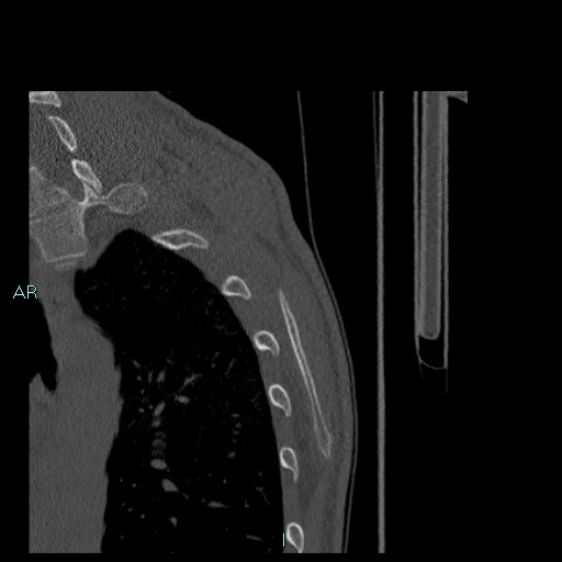 Avascular necrosis after fracture dislocations of the proximal humerus (Radiopaedia 88078-104655 Sagittal bone window 90).jpg