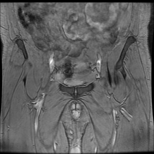 Avascular necrosis of the hip (Radiopaedia 61503-69465 F 14).jpg