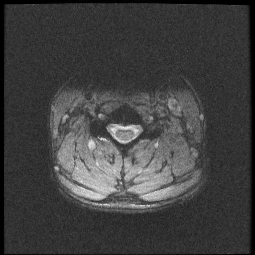 File:Axis fracture - MRI (Radiopaedia 71925-82375 Axial T2 fat sat 13).jpg