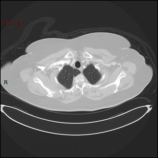 Azygos fissure and lobe (Radiopaedia 47620-52278 Axial lung window 12).jpg