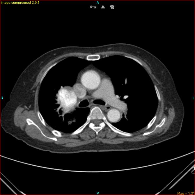 Azygos vein aneurysm (Radiopaedia 77824-90130 B 27).jpg