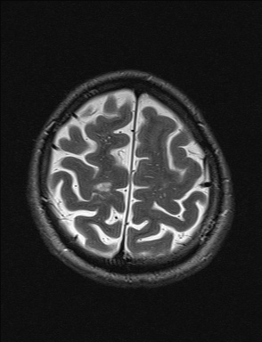 File:Balo concentric sclerosis (Radiopaedia 50458-55940 Axial T2 7).jpg