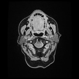 Balo concentric sclerosis (Radiopaedia 53875-59982 Axial LAVA C+ 5).jpg