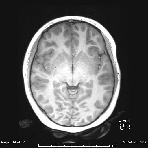 Balo concentric sclerosis (Radiopaedia 61637-69636 Axial T1 39).jpg