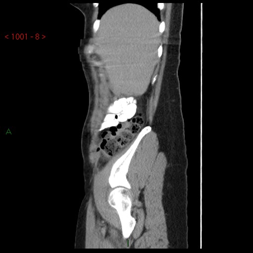 File:Bartholin gland cyst (Radiopaedia 54904-61181 Sagittal C+ delayed 8).jpg