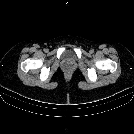 Bartholin gland cyst (Radiopaedia 62635-70930 Axial non-contrast 79).jpg
