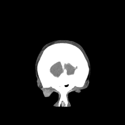 Basilar and bilateral vertebral artery occlusion (Radiopaedia 45592-49723 B 10).png