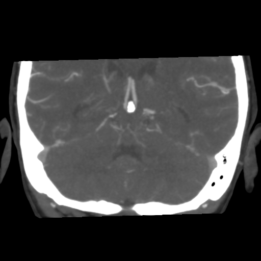 Basilar artery fenestration and aneurysms with subarachnoid hemorrhage (Radiopaedia 40066-42573 B 37).png