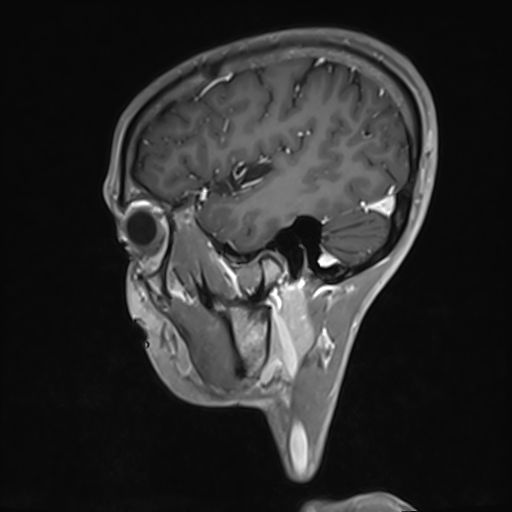 Basilar artery perforator aneurysm (Radiopaedia 82455-97733 G 33).jpg