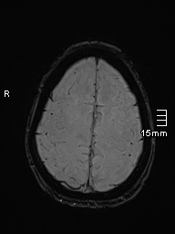 Basilar artery perforator aneurysm (Radiopaedia 82455-99523 Axial SWI 55).jpg