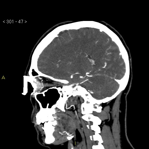 File:Basilar artery thrombosis (Radiopaedia 16260-15944 C 41).jpg
