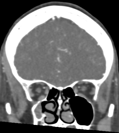 Basilar tip aneurysm with coiling (Radiopaedia 53912-60086 B 34).jpg