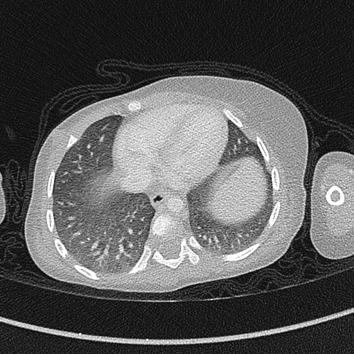 Beckwith-Wiedeman syndrome with bilateral Wilms tumors (Radiopaedia 60850-68629 Axial lung window 46).jpg