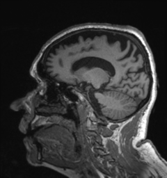 Behavioral variant frontotemporal dementia and late onset schizophrenia (Radiopaedia 52197-58083 Sagittal T1 35).png
