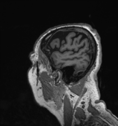 Behavioral variant frontotemporal dementia and late onset schizophrenia (Radiopaedia 52197-58083 Sagittal T1 98).png