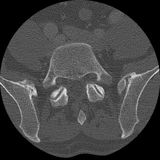 Benign post-traumatic pseudopneumoperitoneum (Radiopaedia 71199-81495 Axial bone window 276).jpg