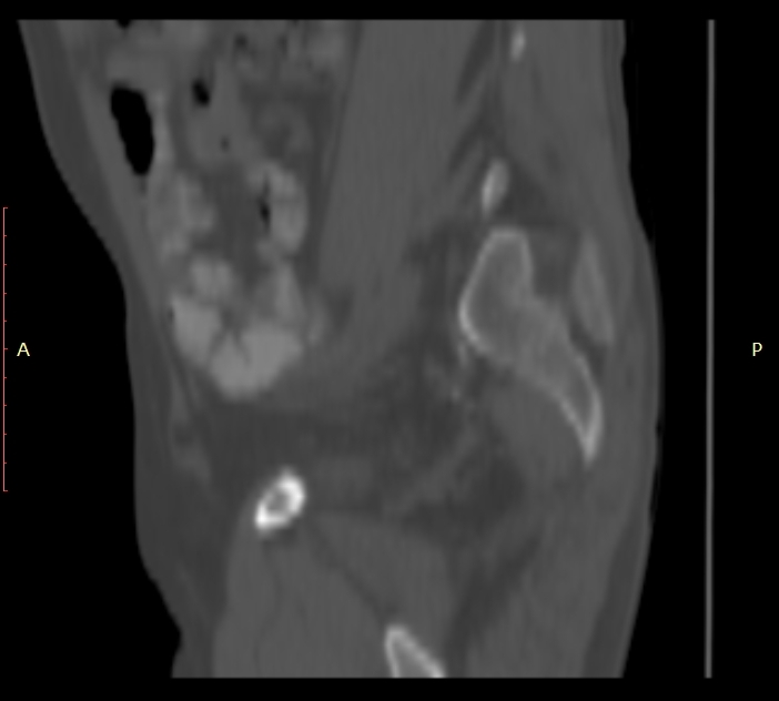 Bertolotti syndrome (Radiopaedia 58974-66235 Sagittal bone window 3).jpg