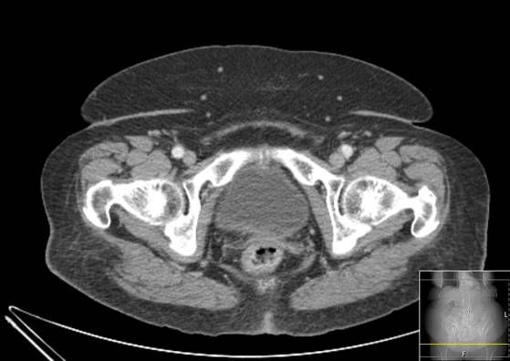 Bicameral celiacomesenteric aneurysm (Radiopaedia 55766-62327 A 71).jpg