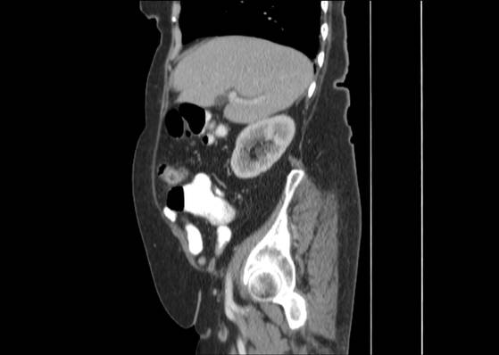 Bicameral celiacomesenteric aneurysm (Radiopaedia 55766-62327 B 18).jpg