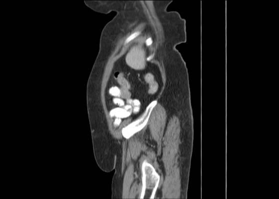 Bicameral celiacomesenteric aneurysm (Radiopaedia 55766-62327 B 50).jpg