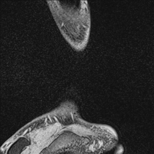 Bilateral Achilles tendon complete tear (Radiopaedia 81344-95051 Sagittal WE - Left 20).jpg