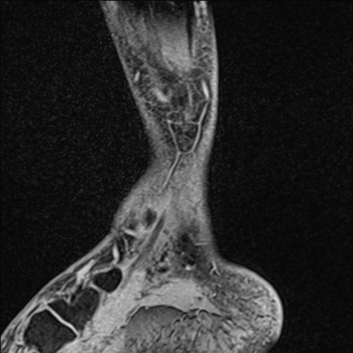 Bilateral Achilles tendon complete tear (Radiopaedia 81344-95051 Sagittal WE - Left 27).jpg