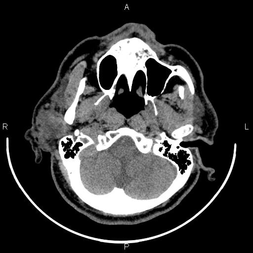 File:Bilateral Warthin tumors (Radiopaedia 84034-99263 Axial non-contrast 10).jpg