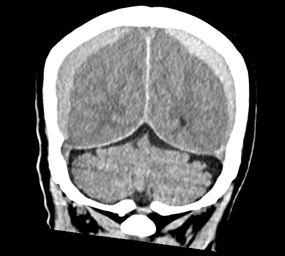 File:Bilateral acute on chronic subdural hematomas (Radiopaedia 78466-91146 Coronal non-contrast 52).jpg