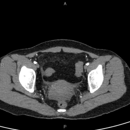 File:Bilateral adrenal gland hyperenhancement in pancreatitis (Radiopaedia 86642-102753 B 114).jpg