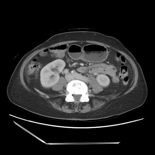 Bilateral adrenal granulocytic sarcomas (chloromas) (Radiopaedia 78375-91007 A 69).jpg