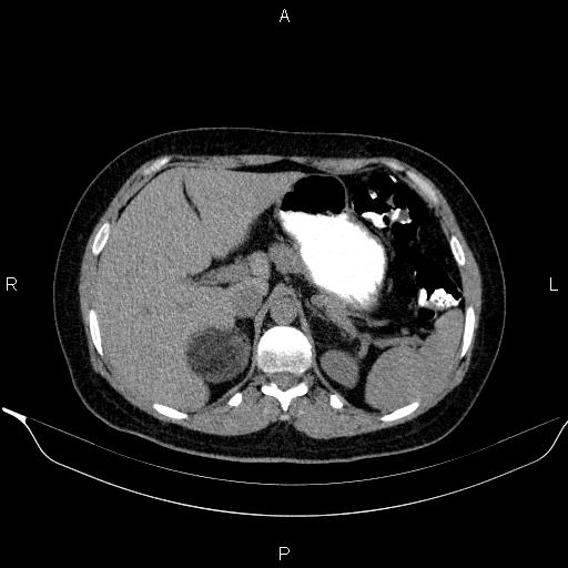 File:Bilateral adrenal myelolipoma (Radiopaedia 63058-71535 Axial non-contrast 42).jpg