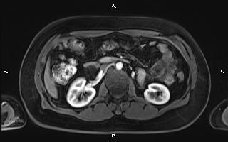 Bilateral adrenal myelolipoma (Radiopaedia 63058-71537 Axial T1 C+ fat sat 50).jpg
